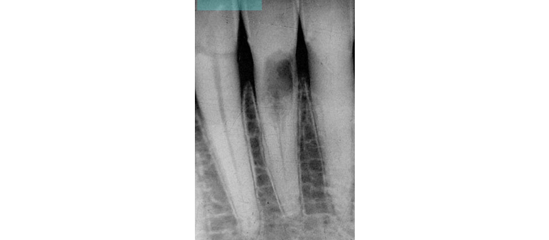 Invasive Cervical Root Resorption: The New Dental Epidemic? LouBerman InvasiveCervicalRootResp Fig.2