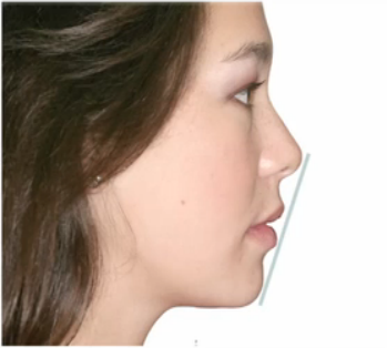 Facial Proportion and Profile