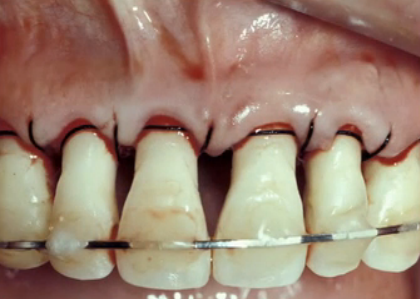 Getting to Know Papillae