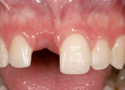 6 Steps For Creating an Ovate Pontic MarkFleming how to create an ovate pontic Fig.1