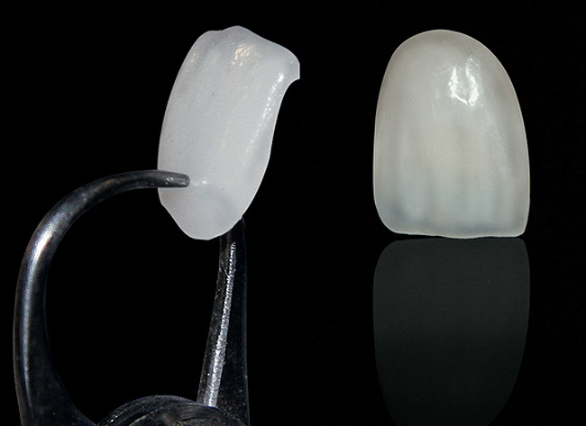 Feldspathic vs. Pressable Ceramic Veneers