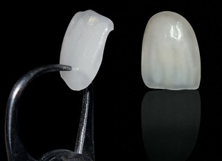 Feldspathic vs. Pressable Ceramic Veneers MartinMendelson Feldspathic Vs. Pressable Ceramic Veneers Fig.1
