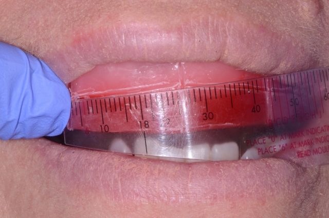 Denture Tooth Selection: Easy With an Accurate Wax Occlusion Rim Mary Anne Salcetti Denture Tooth Selection Featured Image