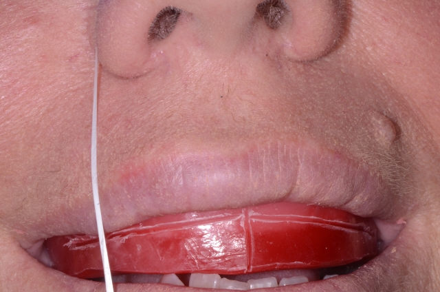 Denture Tooth Selection: Easy With an Accurate Wax Occlusion Rim Mary Anne Salcetti Denture Tooth Selection Figure 1