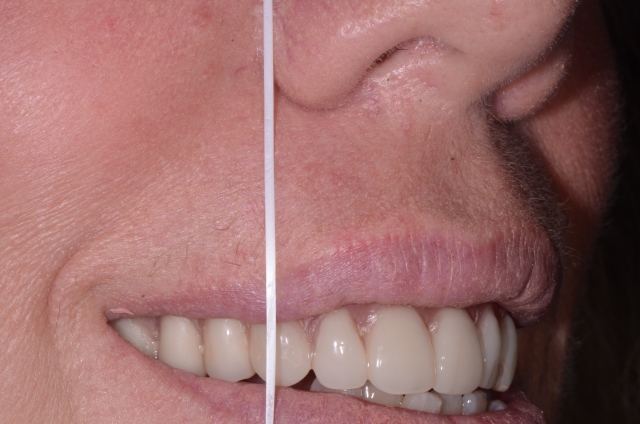 Denture Tooth Selection: Easy With an Accurate Wax Occlusion Rim Mary Anne Salcetti Denture Tooth Selection Figure 2