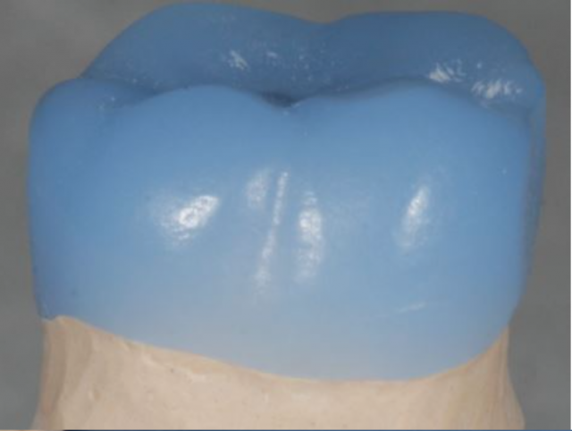 What Is the Best Type of Triple Tray Material? MaryAnneSalcetti what is the best kind of triple tray material Fig.2