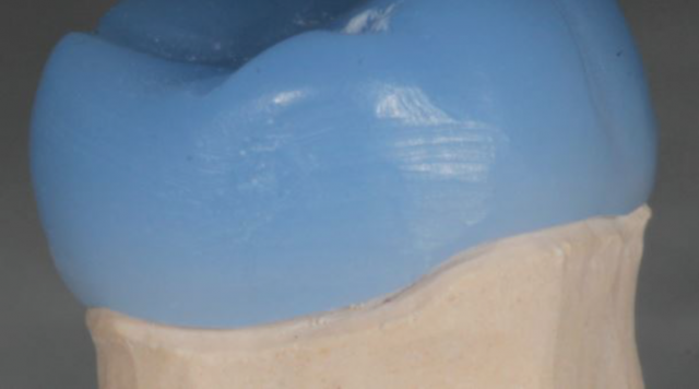 What Is the Best Type of Triple Tray Material? MaryAnneSalcetti what is the best kind of triple tray material Fig.3