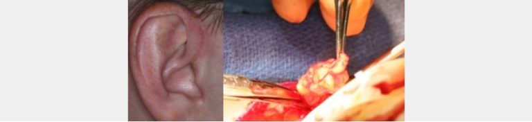 Autogenous Fat: Preferred Material for TMJ Disk Replacement