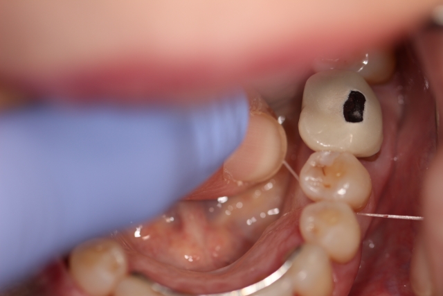 To Floss or Not To Floss: Why Is That a Question? Michael McDevitt To Floss or Not to Floss Why is That a Question Figure 2