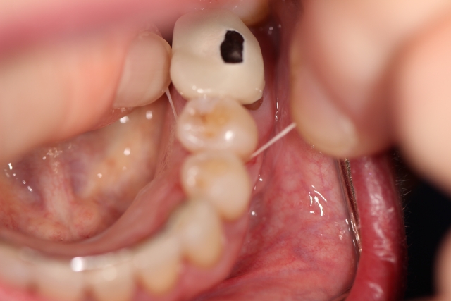 To Floss or Not To Floss: Why Is That a Question? Michael McDevitt To Floss or Not to Floss Why is That a Question Figure 3
