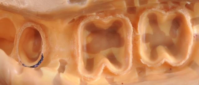 A Guide To Impression-Making: Technique Rationale, Cords Selection and Gingival Manipulation MirelaFerau a guide to impression making technique rationale cords selection and gingival manipulation Fig.1