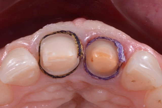 A Guide To Impression-Making: Technique Rationale, Cords Selection and Gingival Manipulation MirelaFerau a guide to impression making technique rationale cords selection and gingival manipulation Fig.10