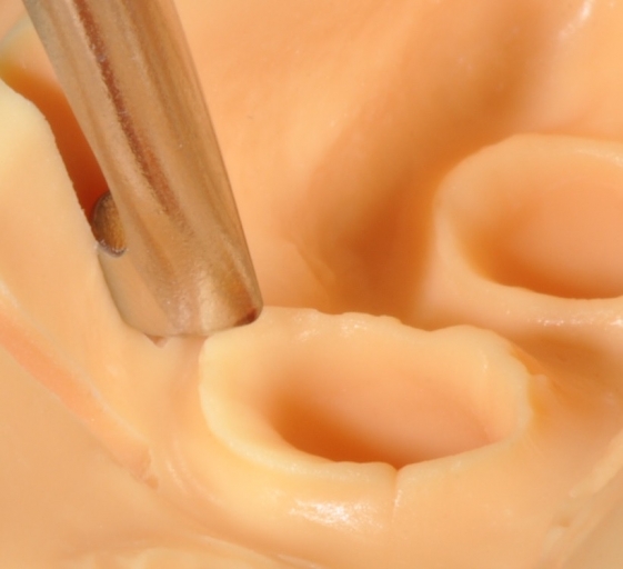 A Guide To Impression-Making: Technique Rationale, Cords Selection and Gingival Manipulation MirelaFerau a guide to impression making technique rationale cords selection and gingival manipulation Fig.11