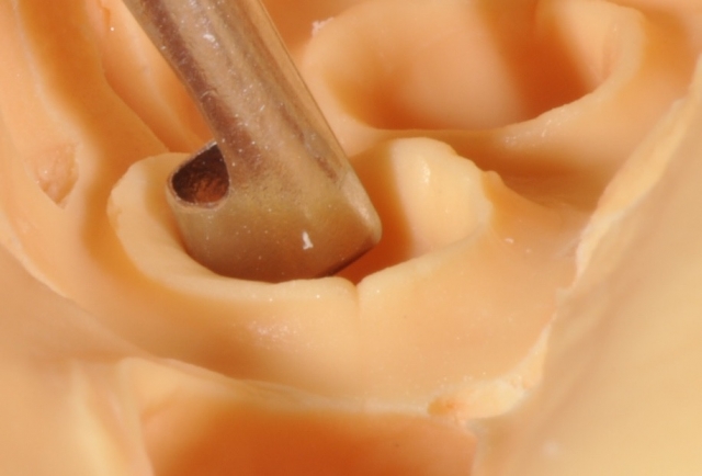A Guide To Impression-Making: Technique Rationale, Cords Selection and Gingival Manipulation MirelaFerau a guide to impression making technique rationale cords selection and gingival manipulation Fig.12