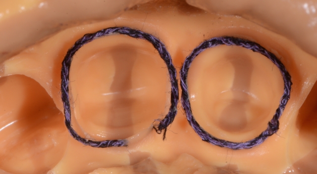 A Guide To Impression-Making: Technique Rationale, Cords Selection and Gingival Manipulation MirelaFerau a guide to impression making technique rationale cords selection and gingival manipulation Fig.14
