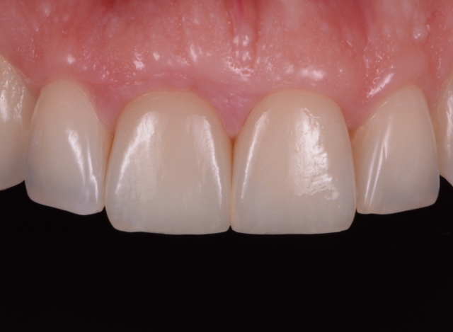 A Guide To Impression-Making: Technique Rationale, Cords Selection and Gingival Manipulation MirelaFerau a guide to impression making technique rationale cords selection and gingival manipulation Fig.15