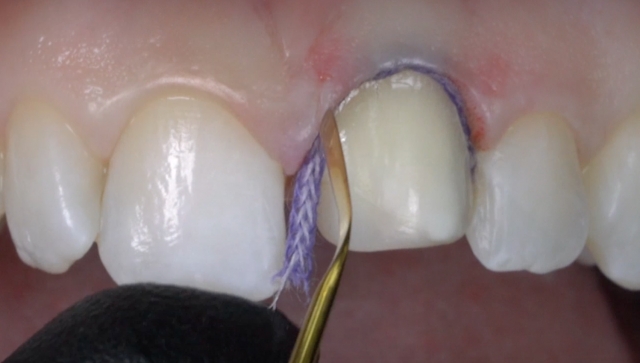 A Guide To Impression-Making: Technique Rationale, Cords Selection and Gingival Manipulation MirelaFerau a guide to impression making technique rationale cords selection and gingival manipulation Fig.16