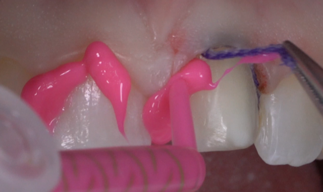 A Guide To Impression-Making: Technique Rationale, Cords Selection and Gingival Manipulation MirelaFerau a guide to impression making technique rationale cords selection and gingival manipulation Fig.17