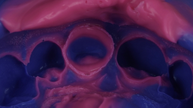 A Guide To Impression-Making: Technique Rationale, Cords Selection and Gingival Manipulation MirelaFerau a guide to impression making technique rationale cords selection and gingival manipulation Fig.18