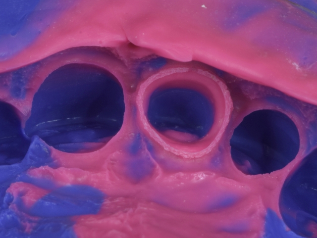 A Guide To Impression-Making: Technique Rationale, Cords Selection and Gingival Manipulation MirelaFerau a guide to impression making technique rationale cords selection and gingival manipulation Fig.2