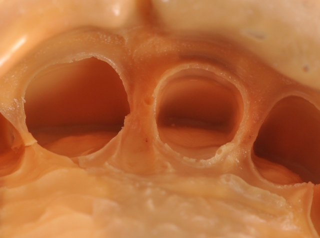 A Guide To Impression-Making: Technique Rationale, Cords Selection and Gingival Manipulation MirelaFerau a guide to impression making technique rationale cords selection and gingival manipulation Fig.3
