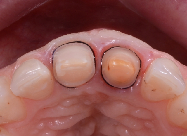 A Guide To Impression-Making: Technique Rationale, Cords Selection and Gingival Manipulation MirelaFerau a guide to impression making technique rationale cords selection and gingival manipulation Fig.6