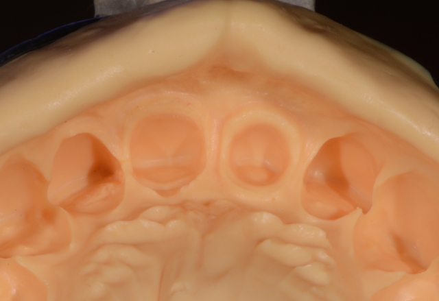 A Guide To Impression-Making: Technique Rationale, Cords Selection and Gingival Manipulation MirelaFerau a guide to impression making technique rationale cords selection and gingival manipulation Fig.7