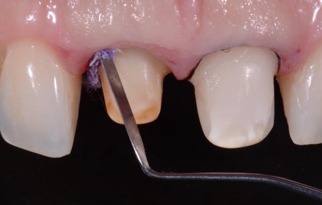 A Guide To Impression-Making: Technique Rationale, Cords Selection and Gingival Manipulation MirelaFerau a guide to impression making technique rationale cords selection and gingival manipulation Fig.8