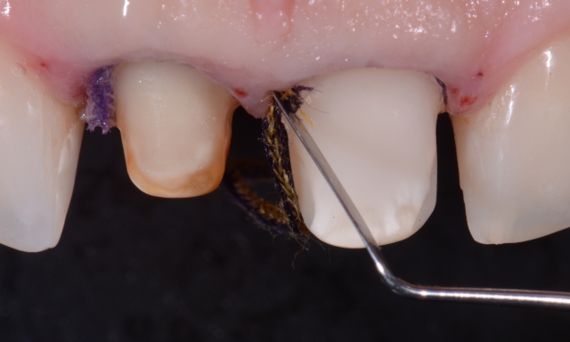 A Guide To Impression-Making: Technique Rationale, Cords Selection and Gingival Manipulation MirelaFerau a guide to impression making technique rationale cords selection and gingival manipulation Fig.9