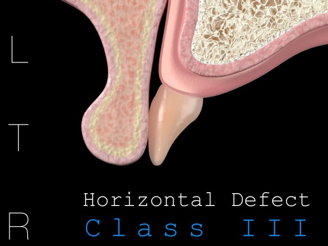 An Introduction to Lip, Tooth, Ridge Classification Mitrani Lip Tooth Ridge Featured Image