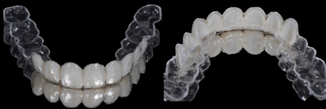 6 Steps to Creating a Removable Veneer Temporary Mitrani Veneer Temporary Featured Image