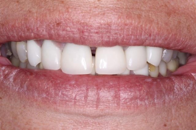 How to Close a Diastema Puneet Sandhu How to Close a Diastema Figure 1