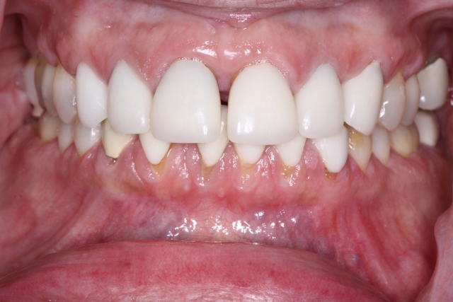 How to Close a Diastema Puneet Sandhu How to Close a Diastema Figure 2