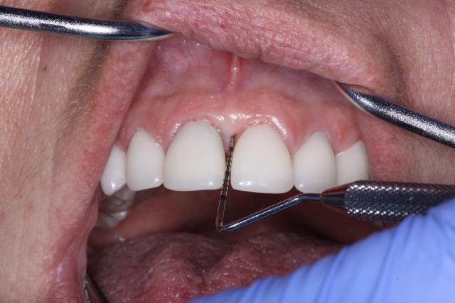 How to Close a Diastema Puneet Sandhu How to Close a Diastema Figure 5