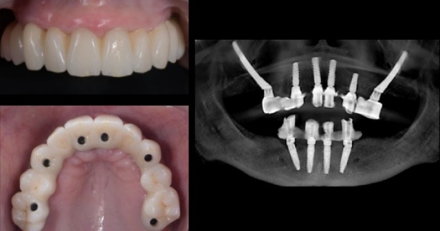 Ricardo Mitrani Zygomatic Implants vs. Bone Grafting for Full Arch Solutions Featured Image