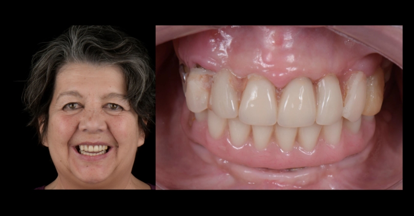 Ricardo Mitrani Zygomatic Implants vs. Bone Grafting for Full Arch Solutions Figure 1