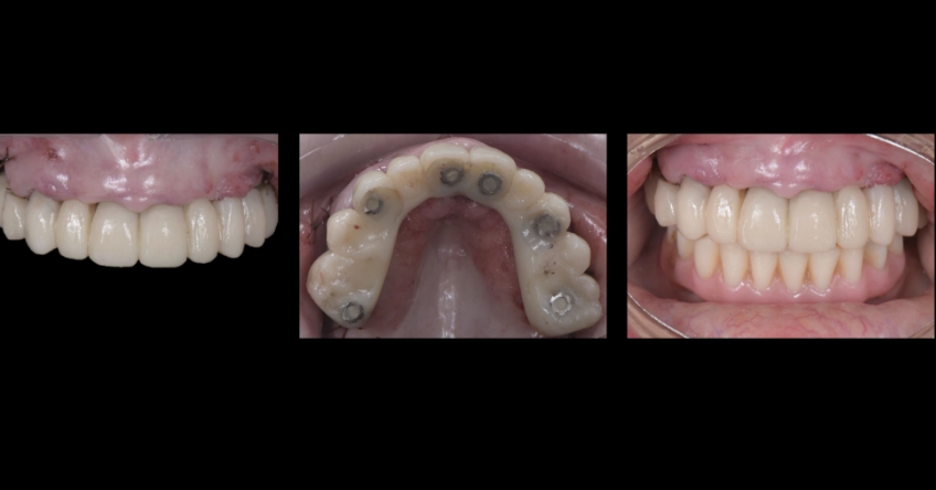 Ricardo Mitrani Zygomatic Implants vs. Bone Grafting for Full Arch Solutions Figure 10