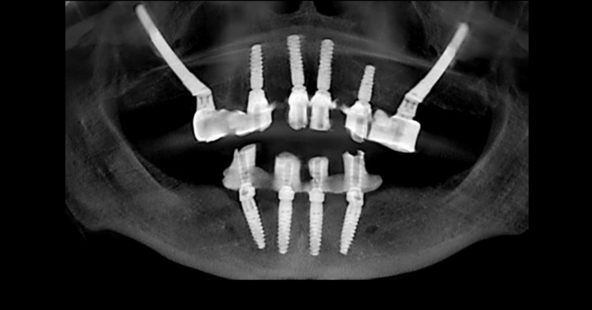 Ricardo Mitrani Zygomatic Implants vs. Bone Grafting for Full Arch Solutions Figure 11
