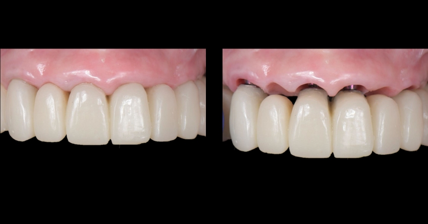 Ricardo Mitrani Zygomatic Implants vs. Bone Grafting for Full Arch Solutions Figure 12