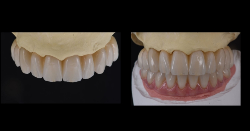Ricardo Mitrani Zygomatic Implants vs. Bone Grafting for Full Arch Solutions Figure 13