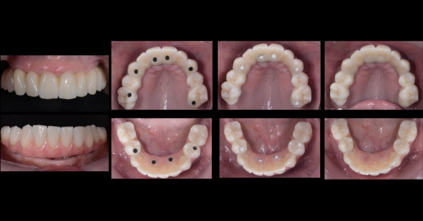 Ricardo Mitrani Zygomatic Implants vs. Bone Grafting for Full Arch Solutions Figure 14