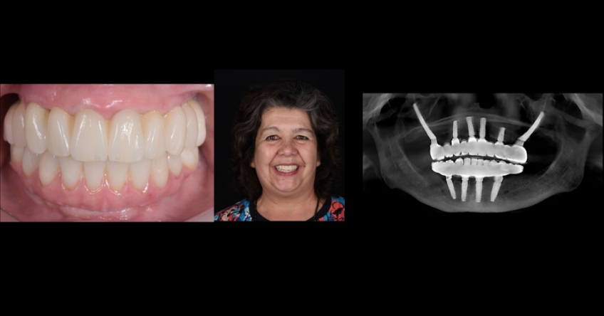 Ricardo Mitrani Zygomatic Implants vs. Bone Grafting for Full Arch Solutions Figure 15