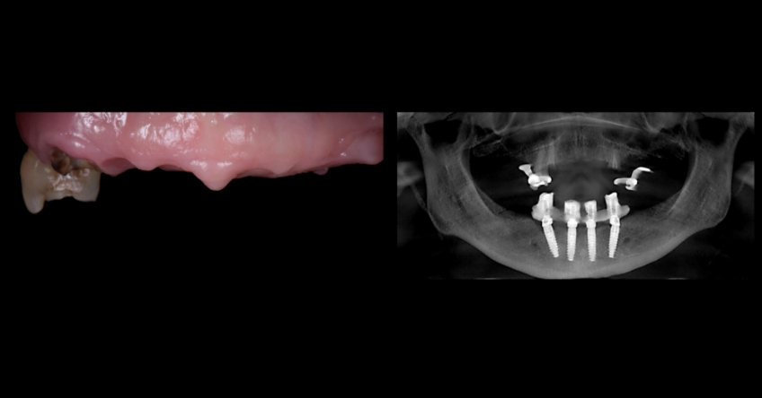Ricardo Mitrani Zygomatic Implants vs. Bone Grafting for Full Arch Solutions Figure 2