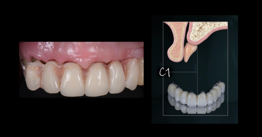 Ricardo Mitrani Zygomatic Implants vs. Bone Grafting for Full Arch Solutions Figure 3
