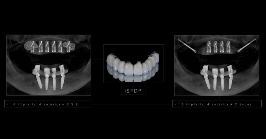 Ricardo Mitrani Zygomatic Implants vs. Bone Grafting for Full Arch Solutions Figure 4