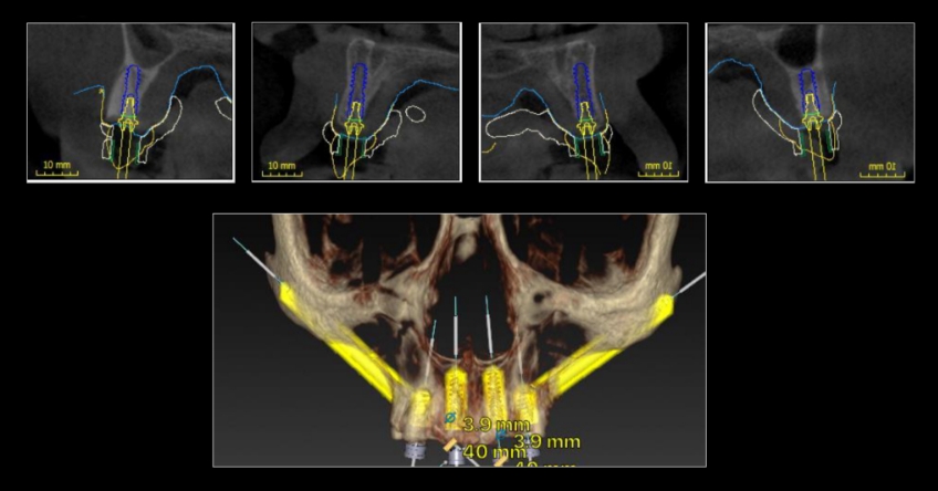 Ricardo Mitrani Zygomatic Implants vs. Bone Grafting for Full Arch Solutions Figure 5