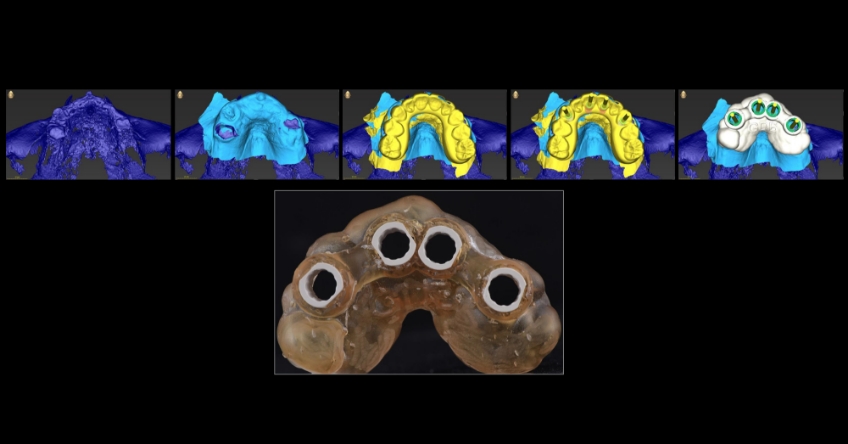 Ricardo Mitrani Zygomatic Implants vs. Bone Grafting for Full Arch Solutions Figure 6