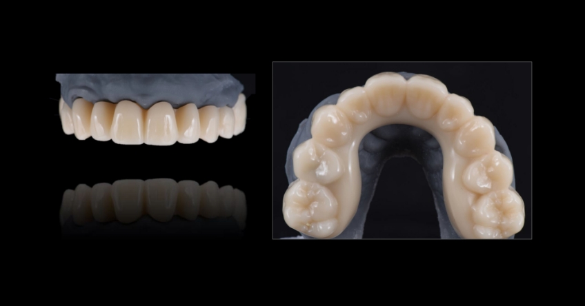 Ricardo Mitrani Zygomatic Implants vs. Bone Grafting for Full Arch Solutions Figure 7