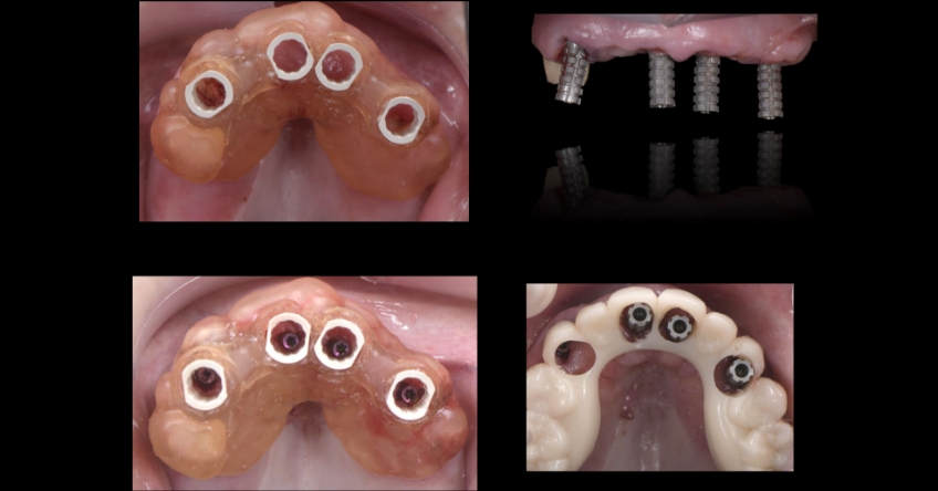 Ricardo Mitrani Zygomatic Implants vs. Bone Grafting for Full Arch Solutions Figure 8
