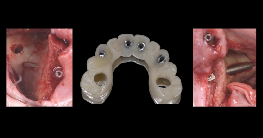 Ricardo Mitrani Zygomatic Implants vs. Bone Grafting for Full Arch Solutions Figure 9